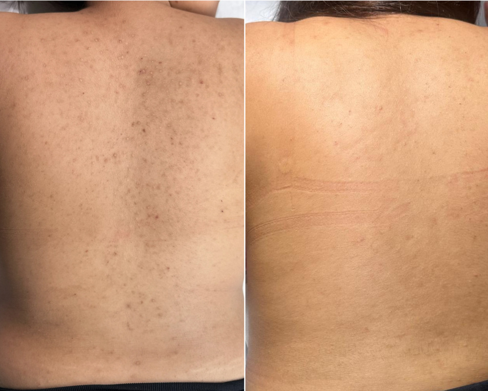 peeling-corps2